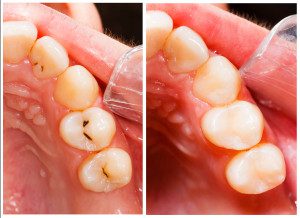 Composite-Filling-Material-Non-Metal-White-Fillings-GrandRapids-Dentist