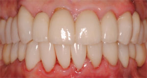 Implants-Crown-Bridge-dental-reconstruction-grand-rapids