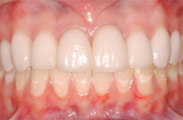 Veneers-after-dental-treatment-at-616-dental-studio