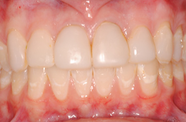 Veneers-before-dental-treatment-at-616-dental-studio
